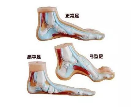 成语平足什么_平足是什么样子图片