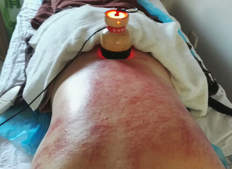 砭石通阳罐刮痧-痧斑的颜色反应不同的症状?