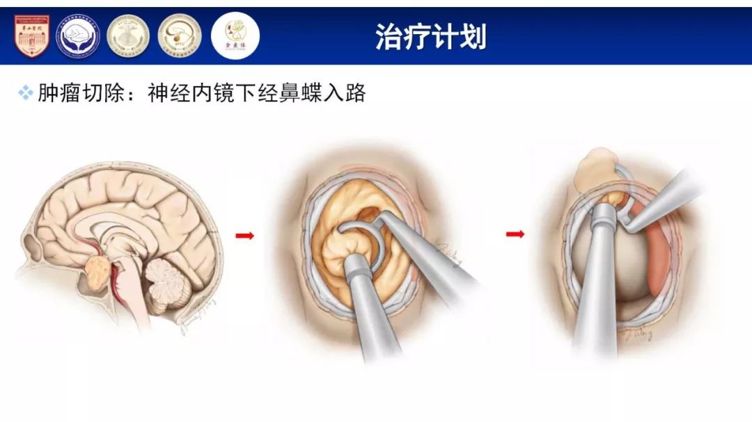 手術演示及會議正在直播5月17日第八屆華山垂體瘤神經內分泌論壇