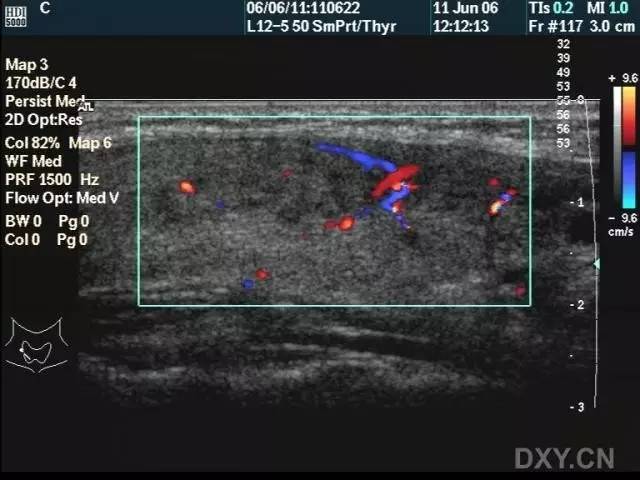 亚甲炎超声表现图像图片