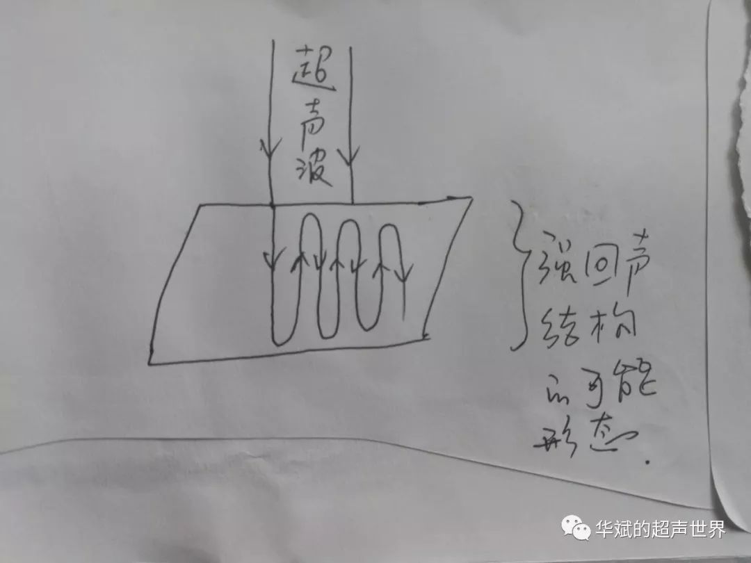 超声伪像:彗星尾征和振铃伪像_回声