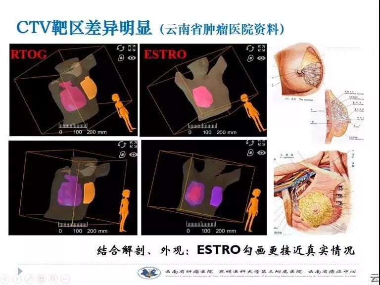 乳腺癌放疗定位图图片