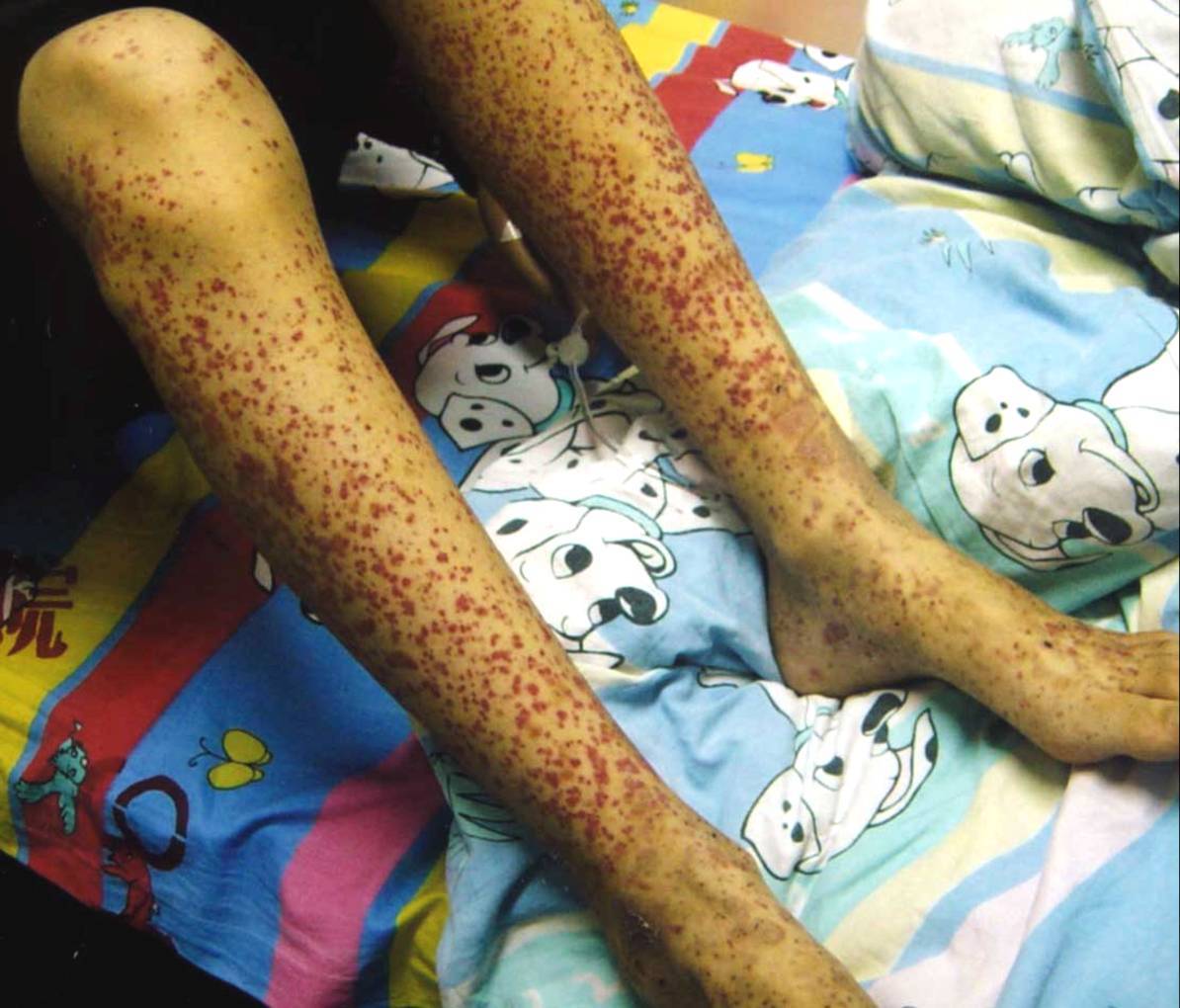 过敏性紫癜患儿的饮食指导及注意事项 (原创)