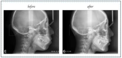 头颅侧位片正畸 测量图片