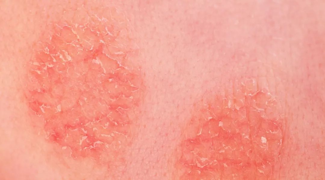 这3点没做对难怪宝宝湿疹好不了