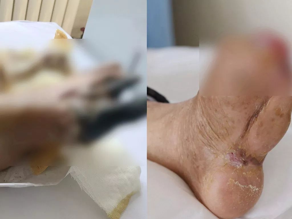 栖霞这位86岁老人为何脚会溃烂到要截肢