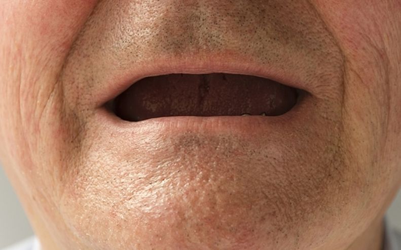 【活动招募】种植牙——缺牙的首选修复方式_牙齿