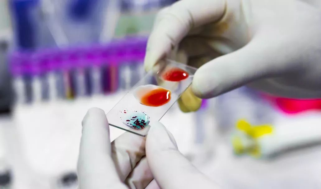 但在血型发生变异或者某些疾病的影响下,血清学方法检测血型会出现