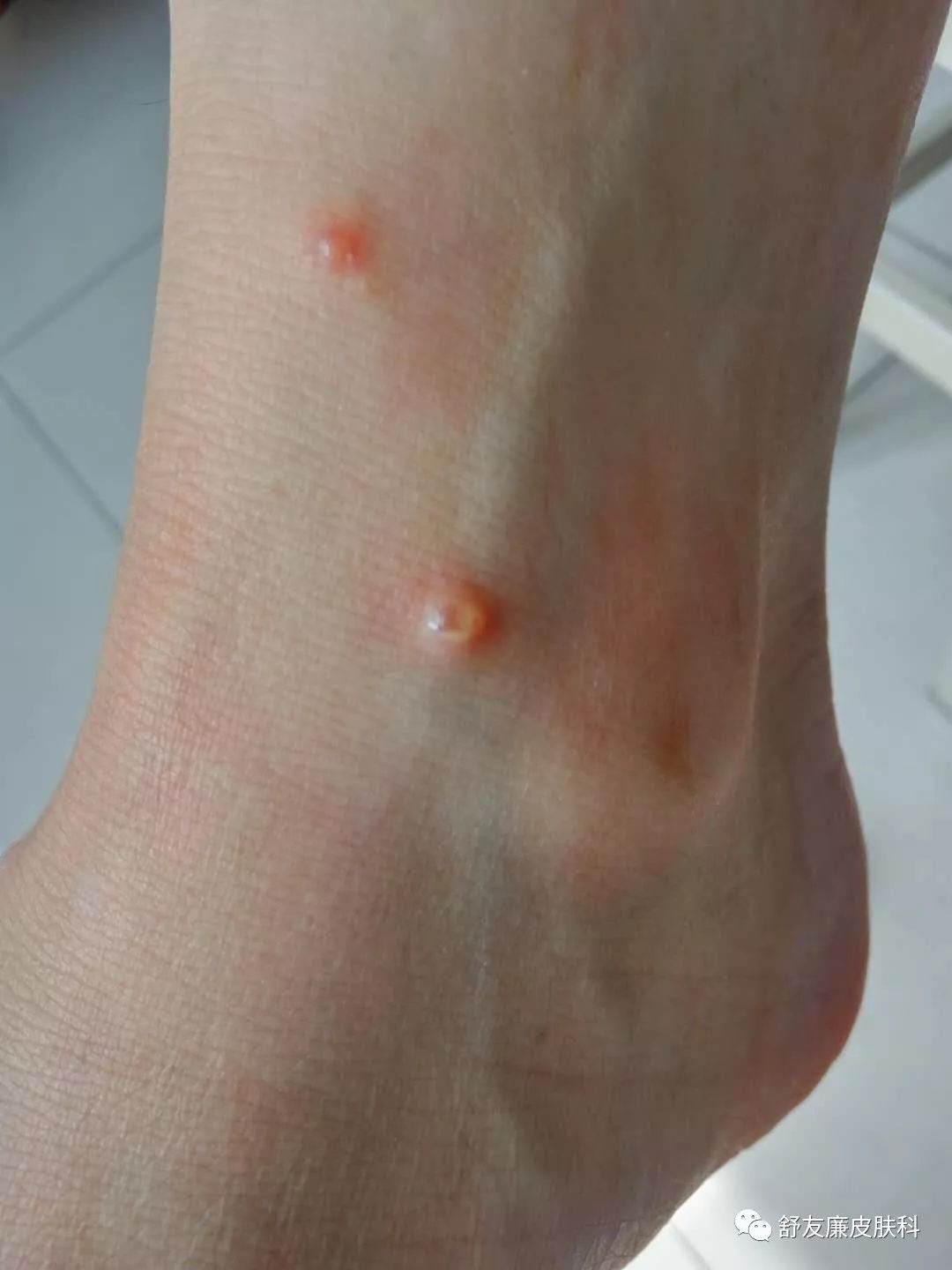 蚊子叮咬可以起水疱