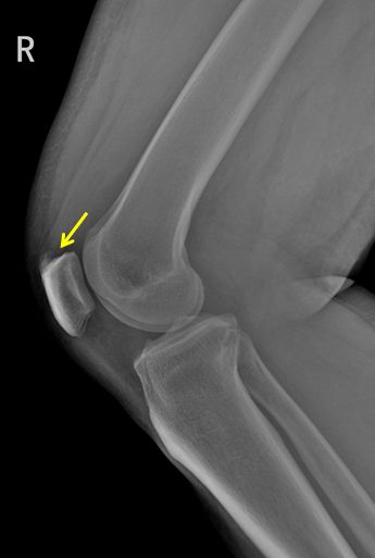 正常髌骨图片
