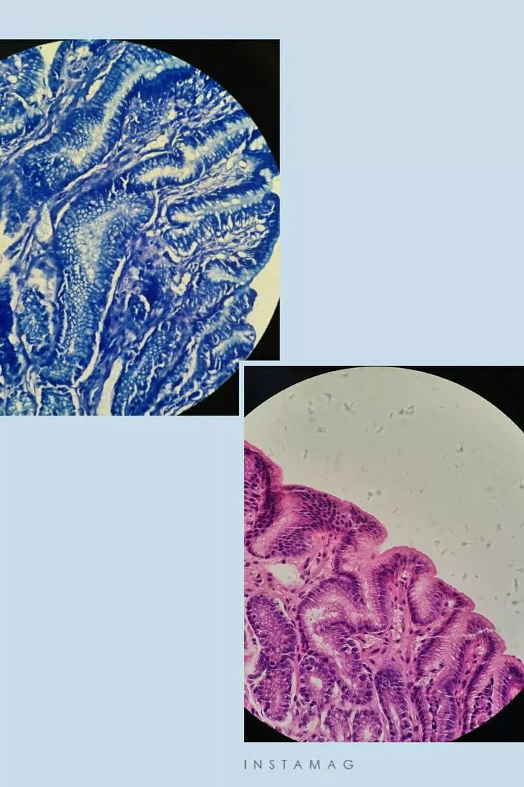 幽门螺旋杆菌病理图片图片