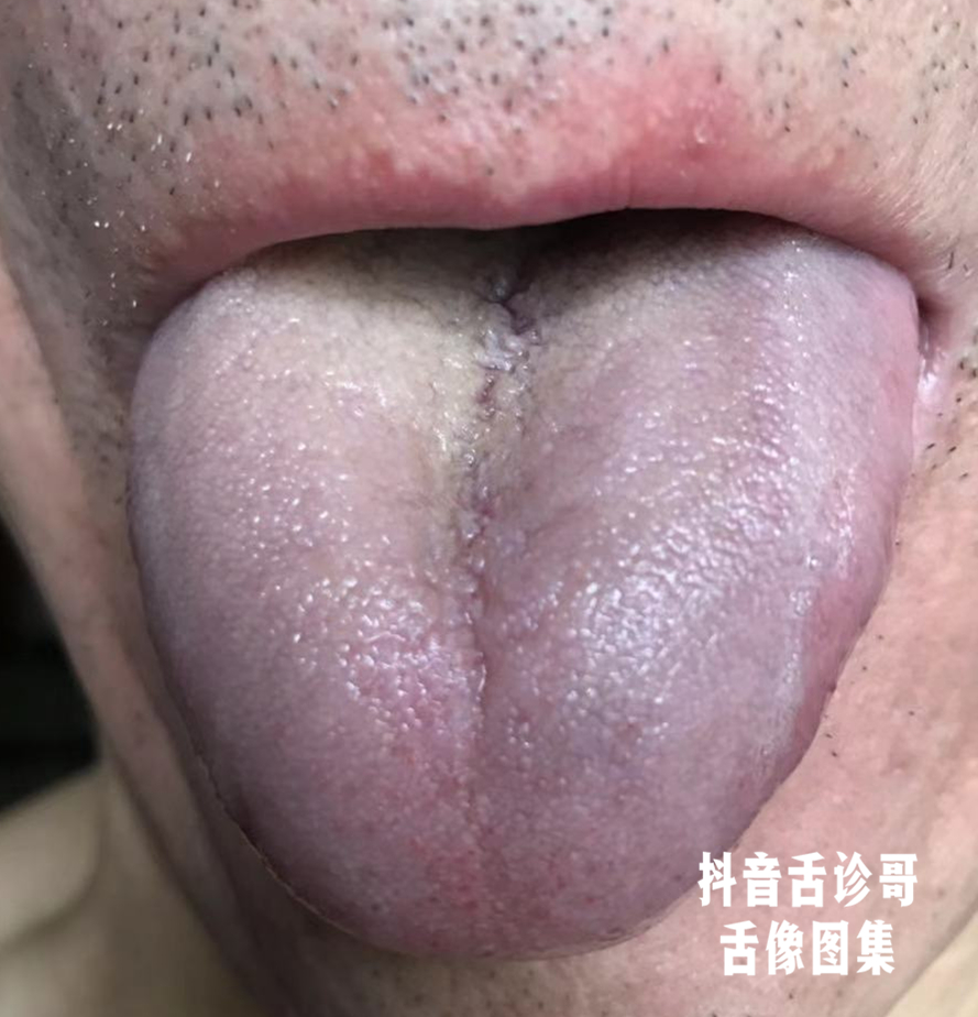抖音舌诊哥舌诊知健康教你学会看舌象系列四十五