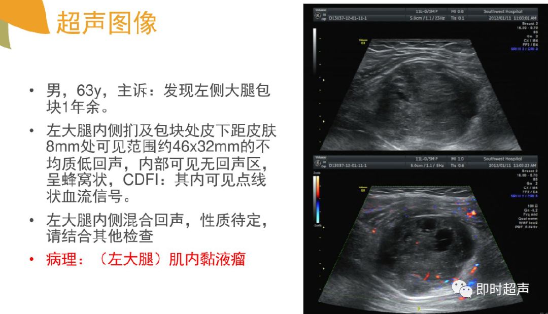 骨软骨瘤超声表现图片