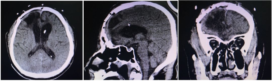 迈普神外之声丨peek材料在颅骨的精准修复