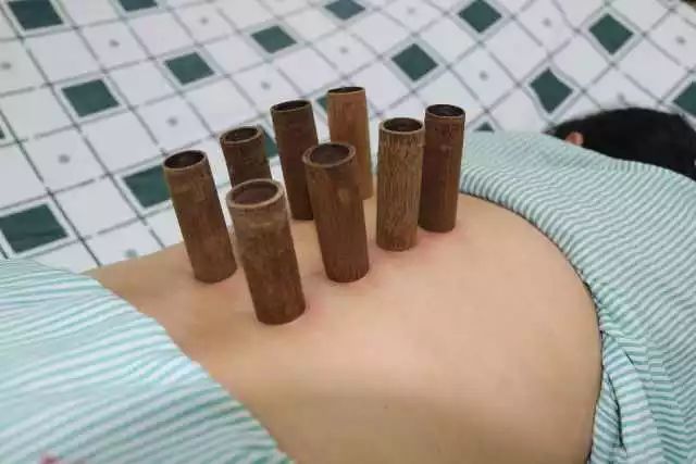 药物罐疗法是在传统拔罐疗法基础上,经过实践创新,将拔罐法与中药疗法