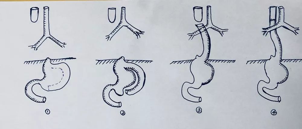 将胃体设计裁剪后,卷成约10厘米长的"管状胃",并将其留置于胸腔,同时