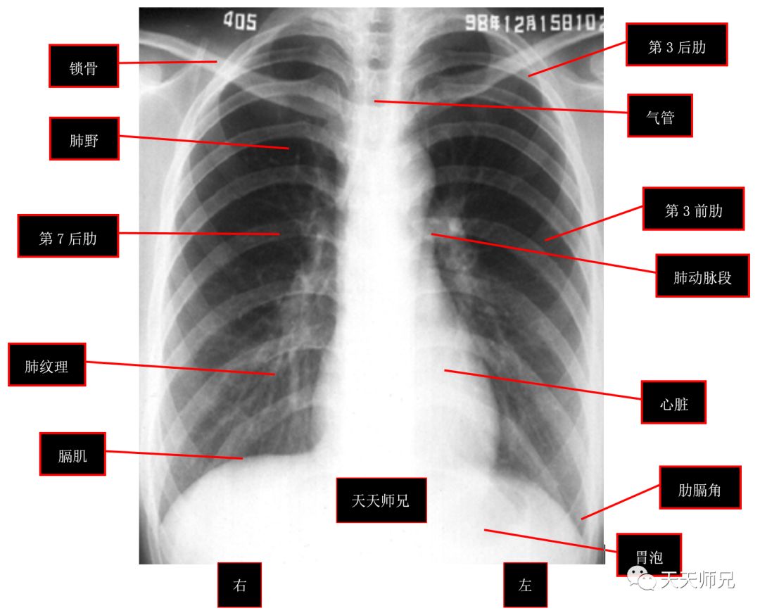 教你如何看肺炎胸片图片