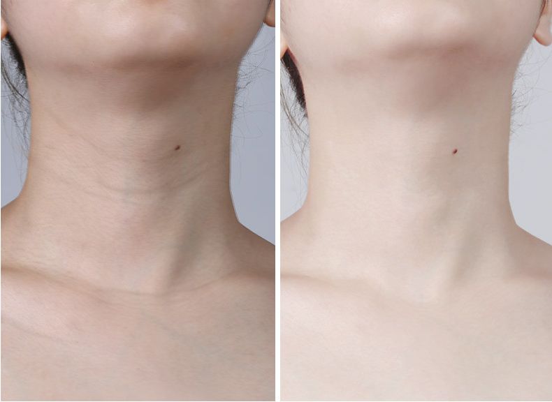 颈部年轮老十岁日本网红超声刀一抹抚平75皱纹