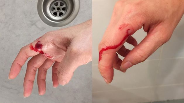 意外受伤别慌学起来