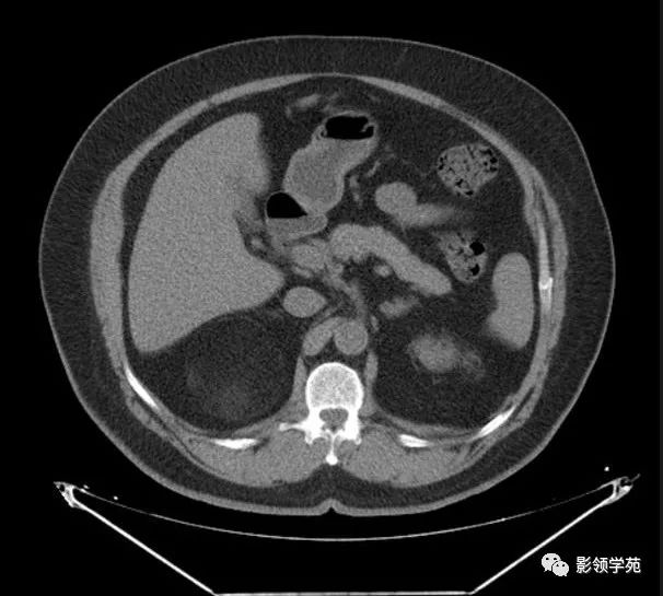 右侧肾上腺髓性脂肪瘤