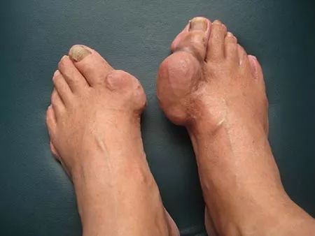 痛风的"受罪羊":你的大脚趾._尿酸