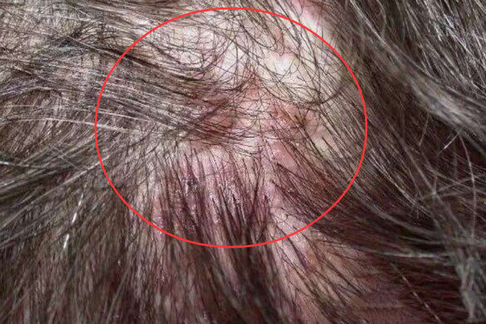 号称不死癌症的头皮毛囊炎,真的摆脱不掉吗?专家说用它能