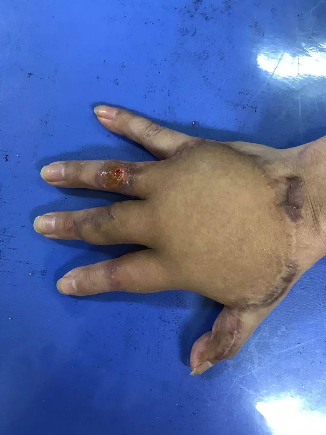 患者手掌毁损,烧伤整形二病区将全手埋腹部保功能