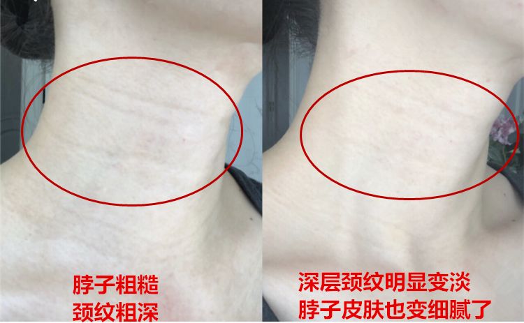 颈部年轮老十岁日本网红超声刀一抹抚平75皱纹