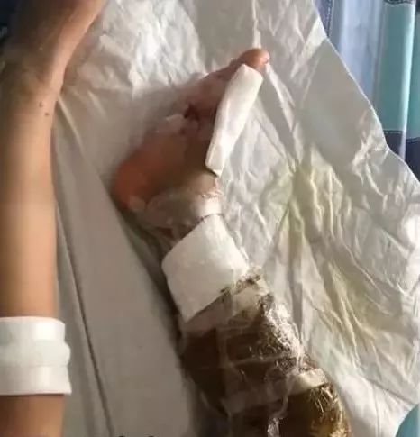 东莞一小区惊现几种毒蛇3岁小孩被咬整条腿都肿了