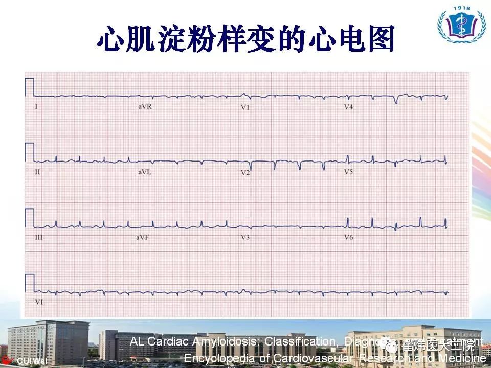 心脏淀粉样变:临床识别与鉴别诊断