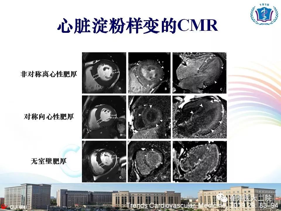 心脏淀粉样变:临床识别与鉴别诊断_幻灯片