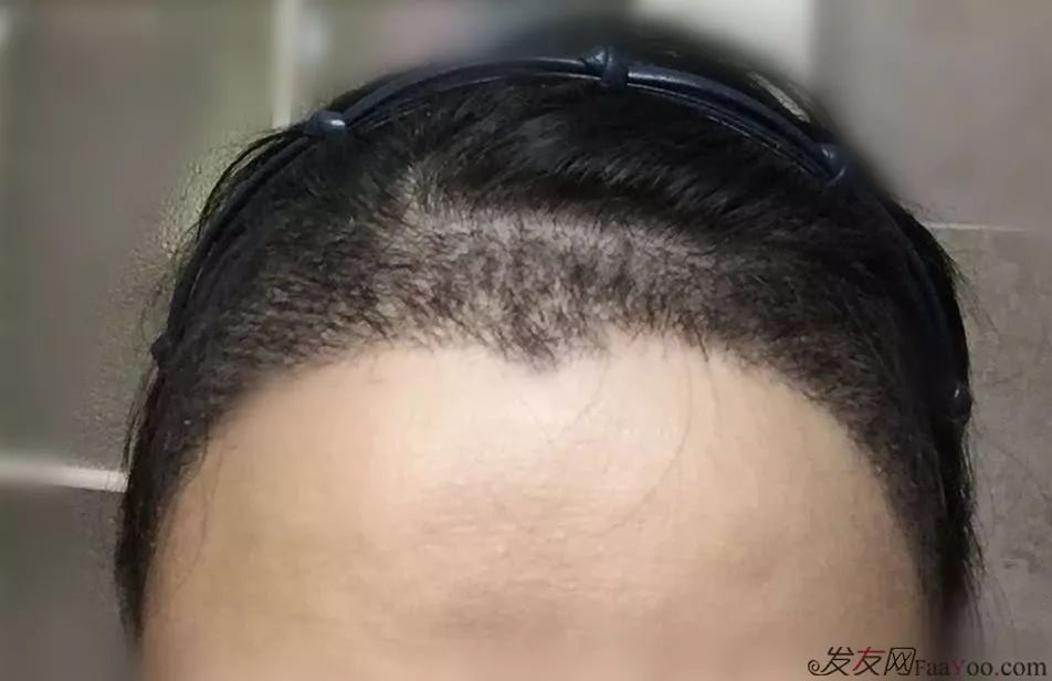 发际线是指什么地方,正常发际线,发际线_大山谷图库