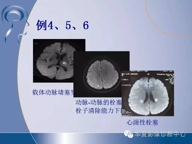 腦小血管病與腔隙性腦梗死