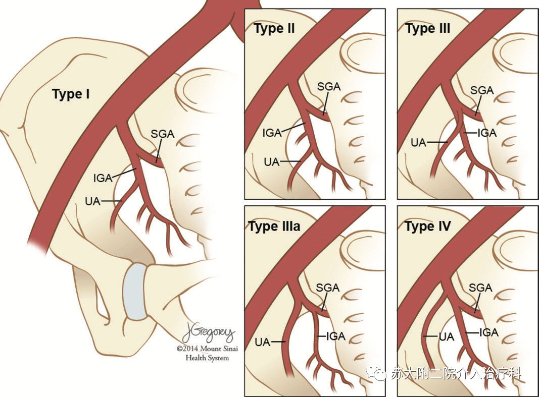 子宫动脉分支模式的血管造影分类图(iga =臀下动脉,sga =臀上动脉,ua
