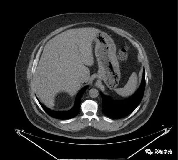 右侧肾上腺髓性脂肪瘤