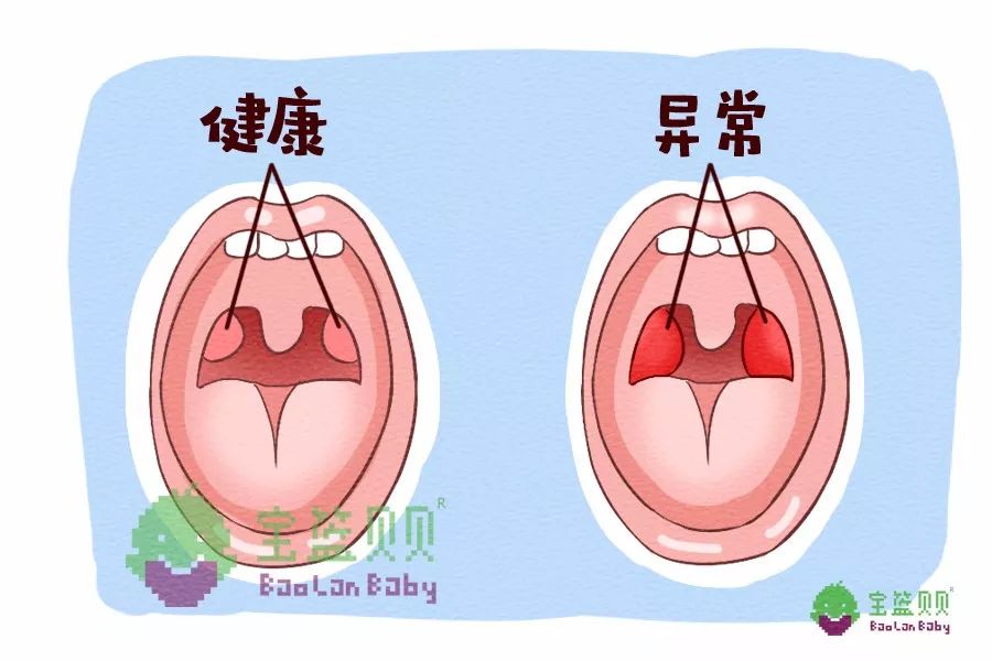 兒童鼻咽部相對較小,當腺樣體或扁桃體肥大時,鼻咽通道變得更窄,氧氣