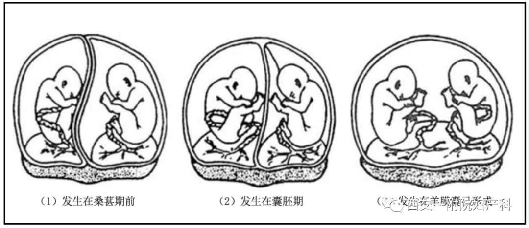 双胎的类型有哪些?_羊膜