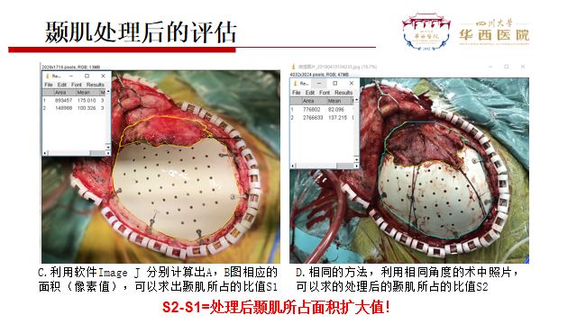 随后,来自四川大学华西医院的杨靖国医师对颞肌处理及peek颅骨修补