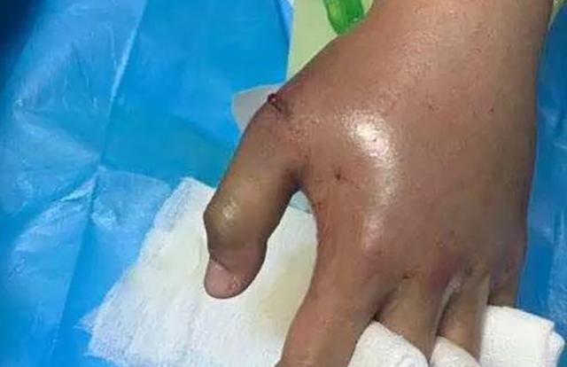 男孩网购竹叶青蛇当宠物喂食时被咬伤评论区网友的话亮了