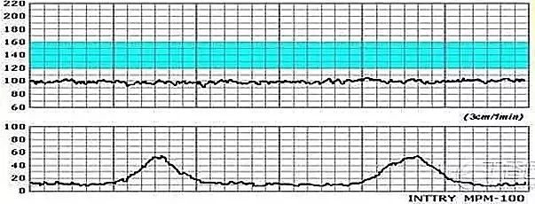心动过缓心率水平至少保持 10 min 大体不变才能确定基础胎心率,若