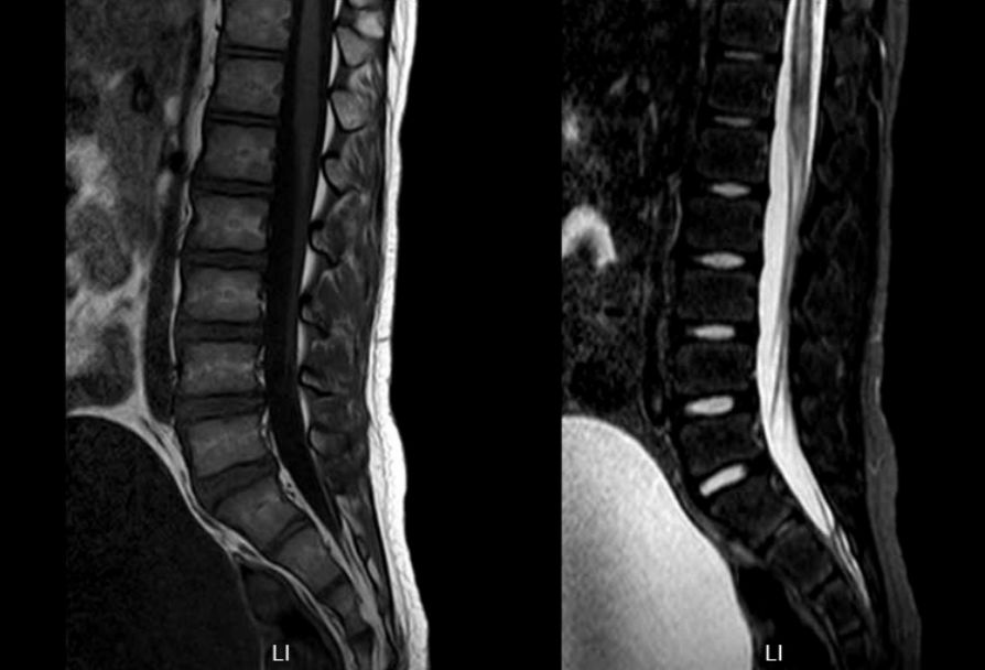脊髓栓系凹陷图片图片