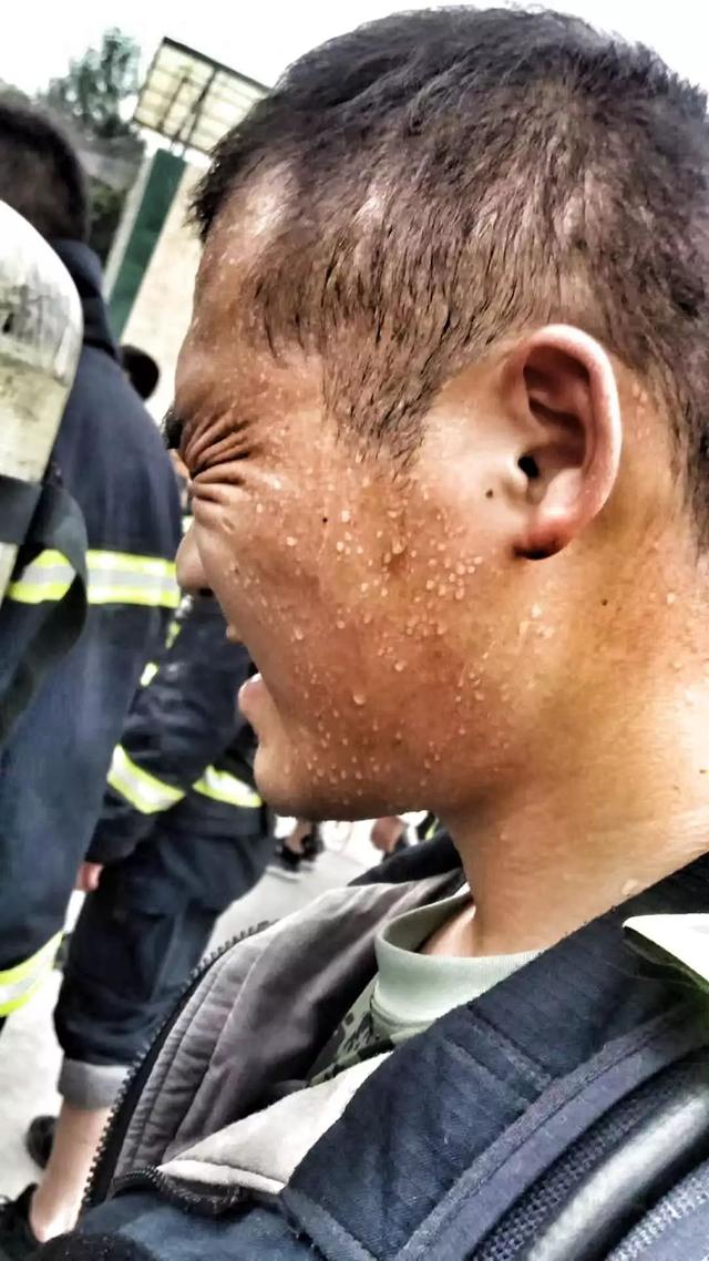 消防员烧伤的脸图片
