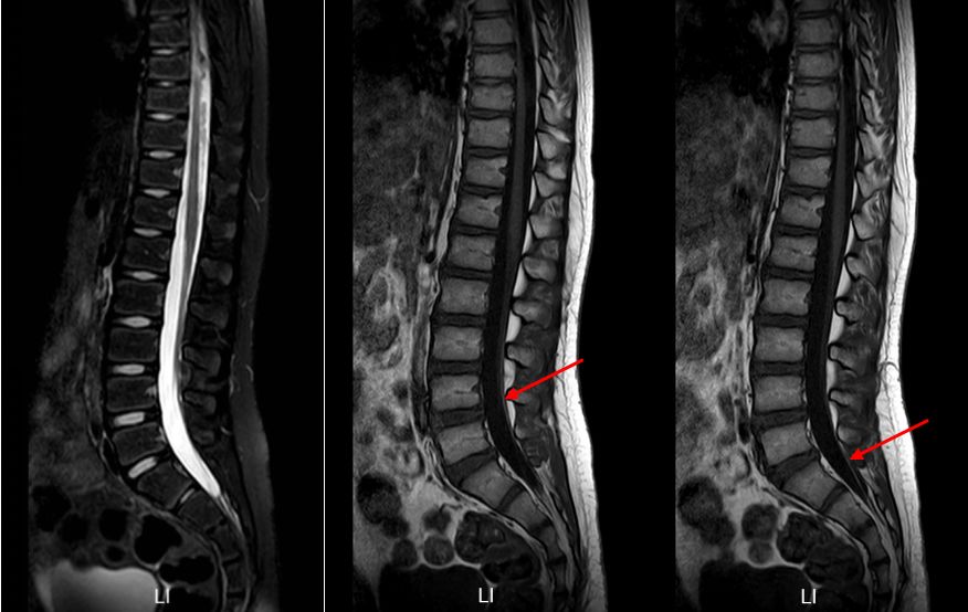 小儿脊髓栓系早期症状图片