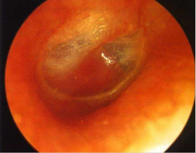 中耳炎耳膜充血图片图片