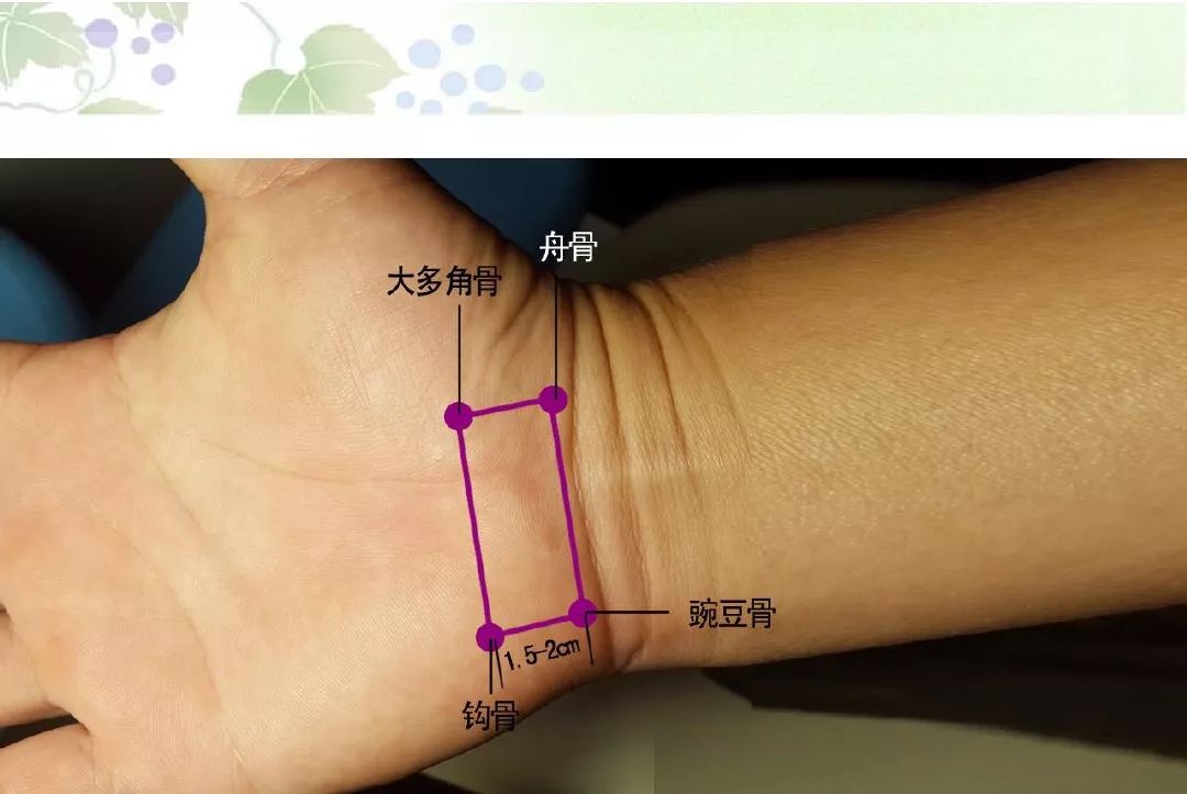 针刀治疗腕管综合征