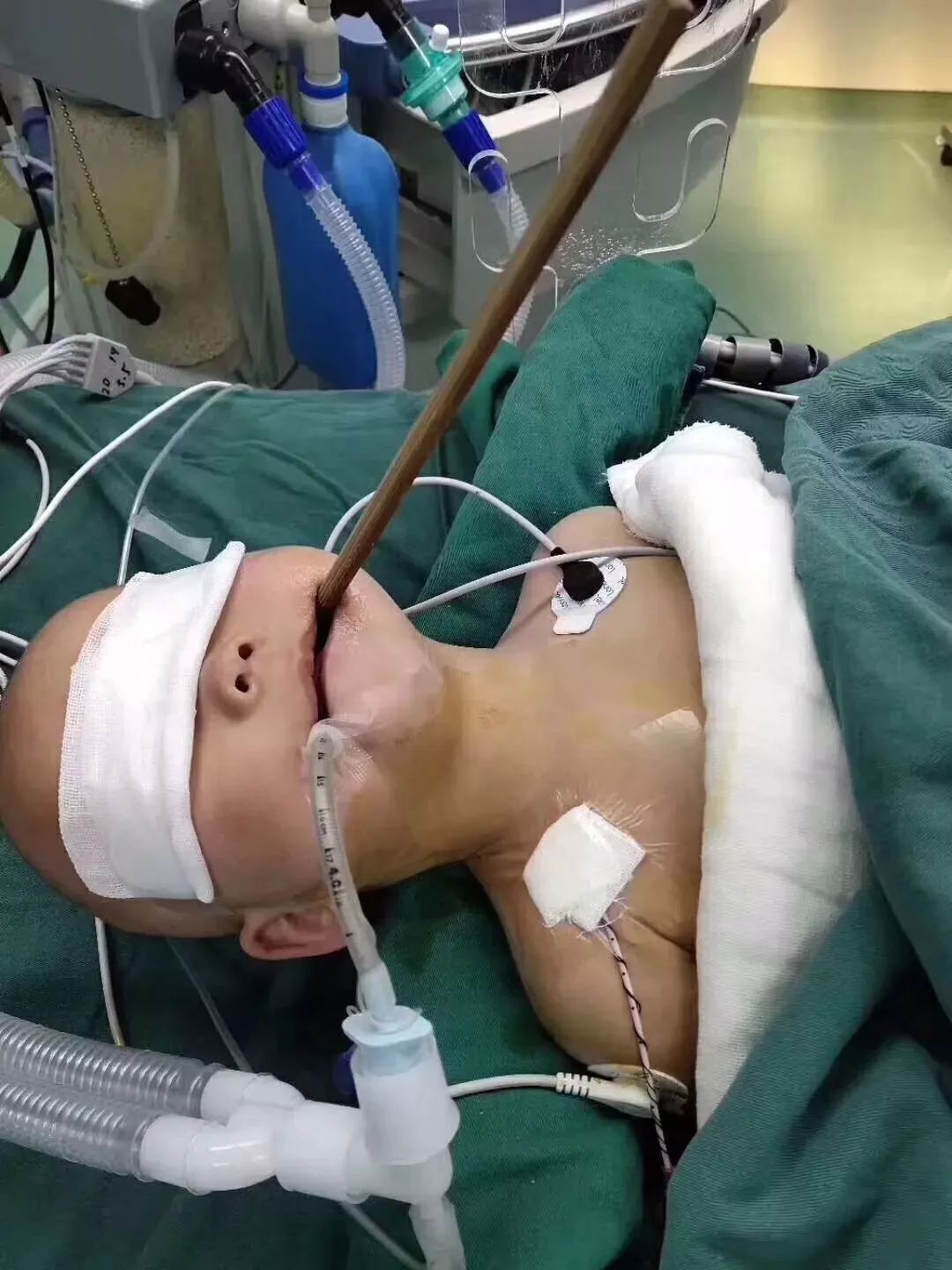 头上的直角线,则是预计开颅手术的位置.