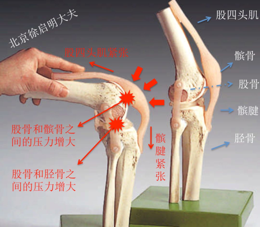 膝关节屈曲130度图解图片