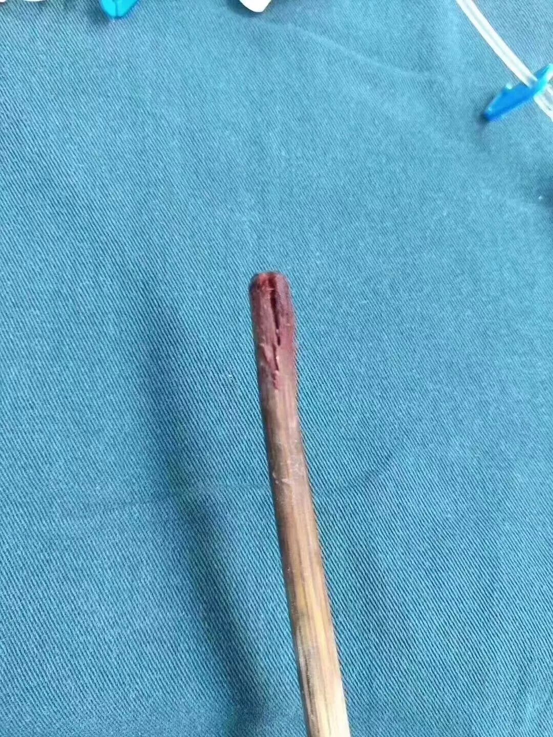 吓人!遵义一男婴拿着筷子玩耍,下一秒筷子就插入嘴中!