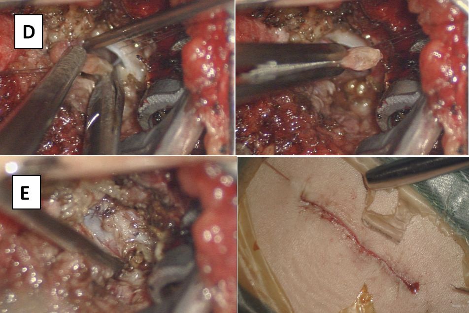 经棘突间入路手术治疗脊髓栓系综合征一例(小儿神经外科系列六)---浙