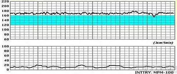 胎心减速的三种情况图图片